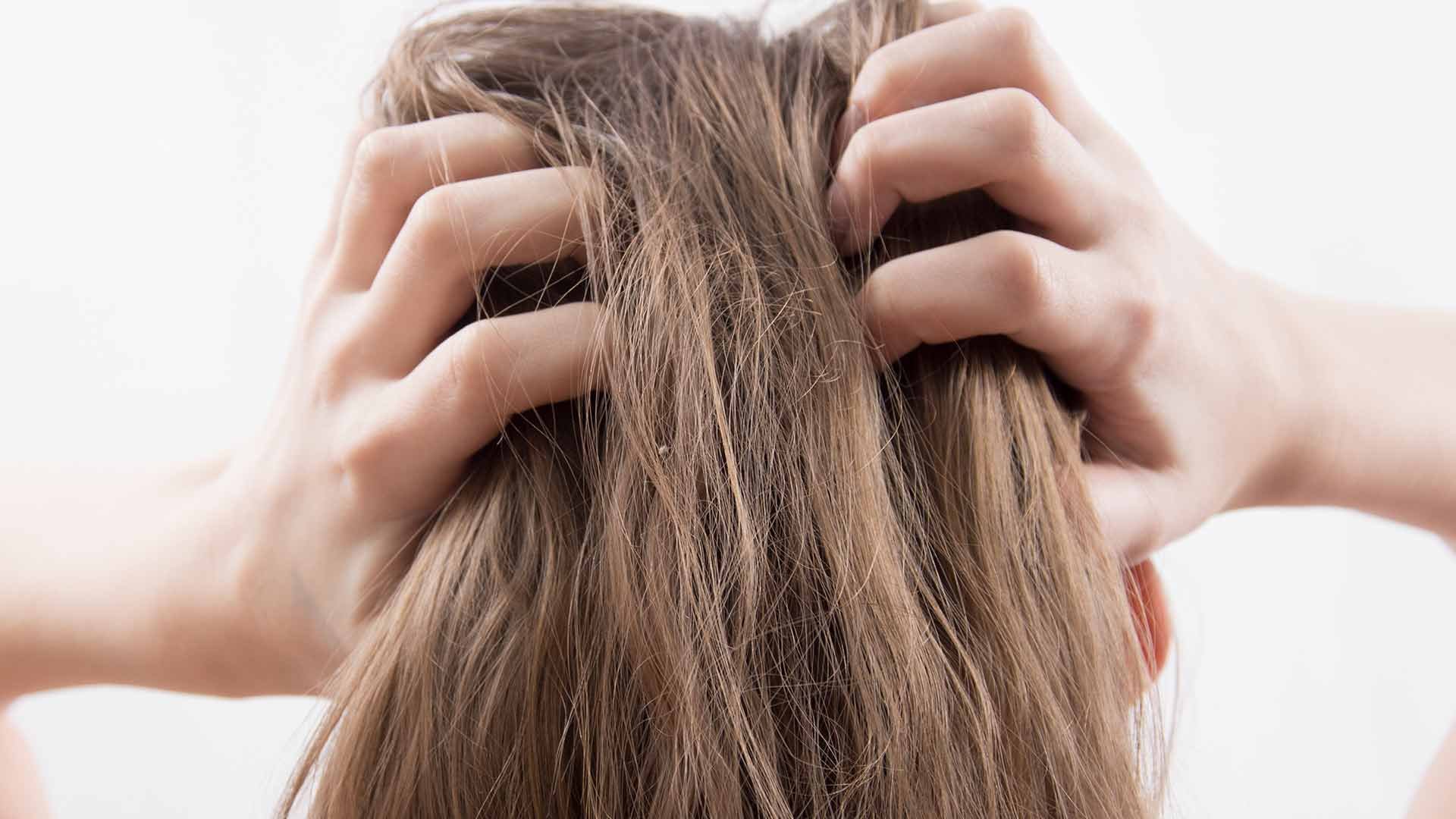 Loreal Paris Article What Is Scalp Psoriasis Causes Symptoms and More D